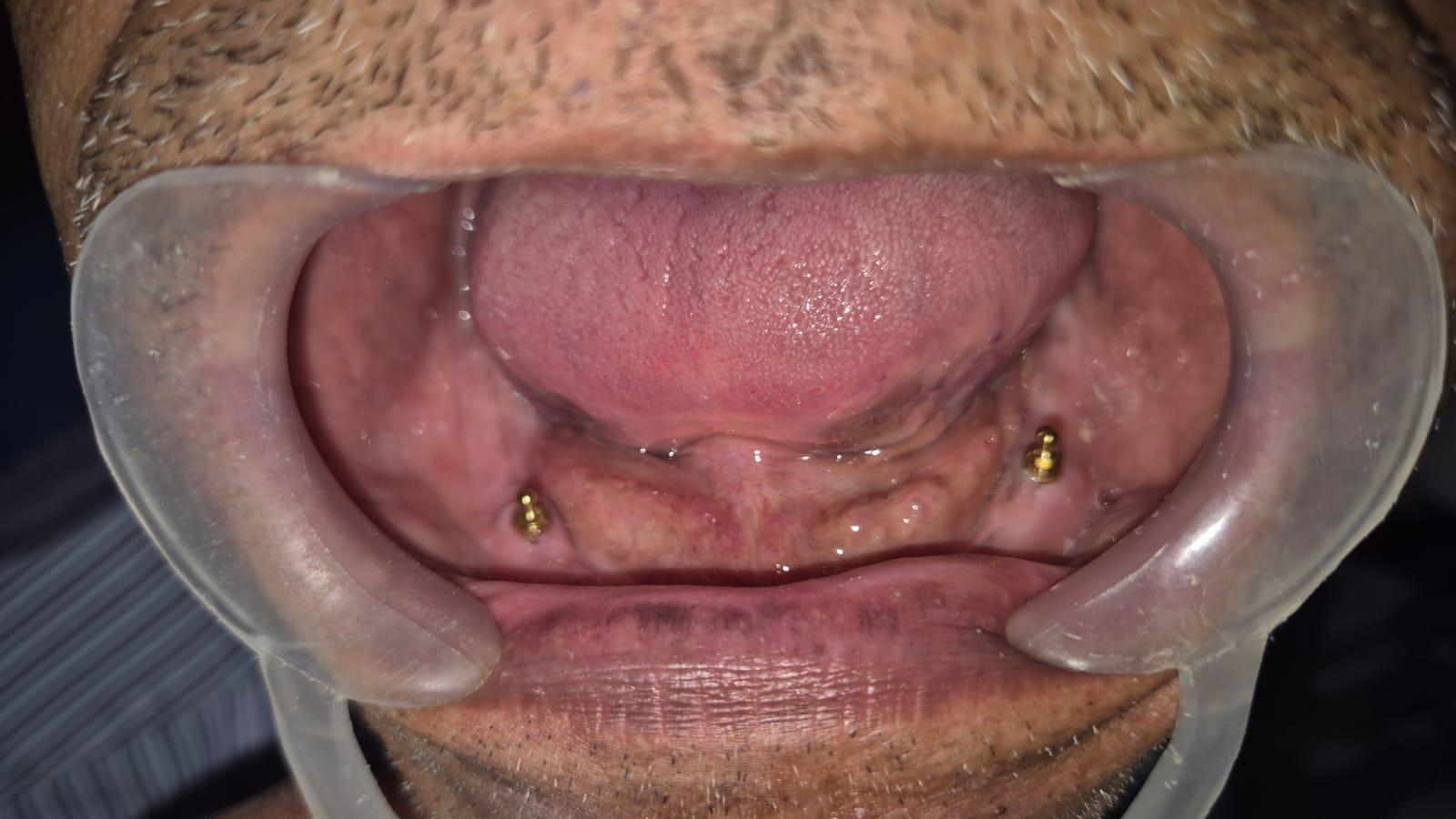Teeth Care Multispeciality Dental Clinic Emerges as the Best Dental Implant Supported Denture Clinic in Kolkata